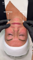 Endolift® by Dr. Milena