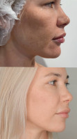 Moxi® - BBL-MOXI-FIN