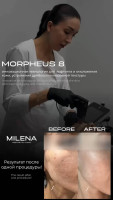 Morpheus8 by Dr. Ayjahan